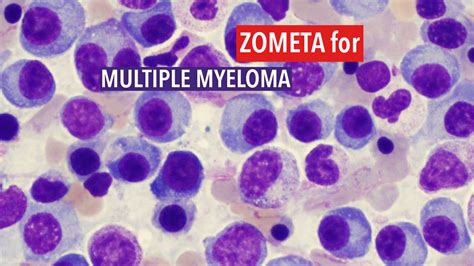 Blood levels of immune cells predict survival in myeloma patients .
